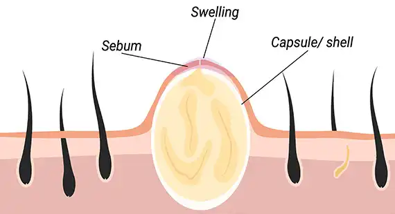 what is sebaceous cysts
